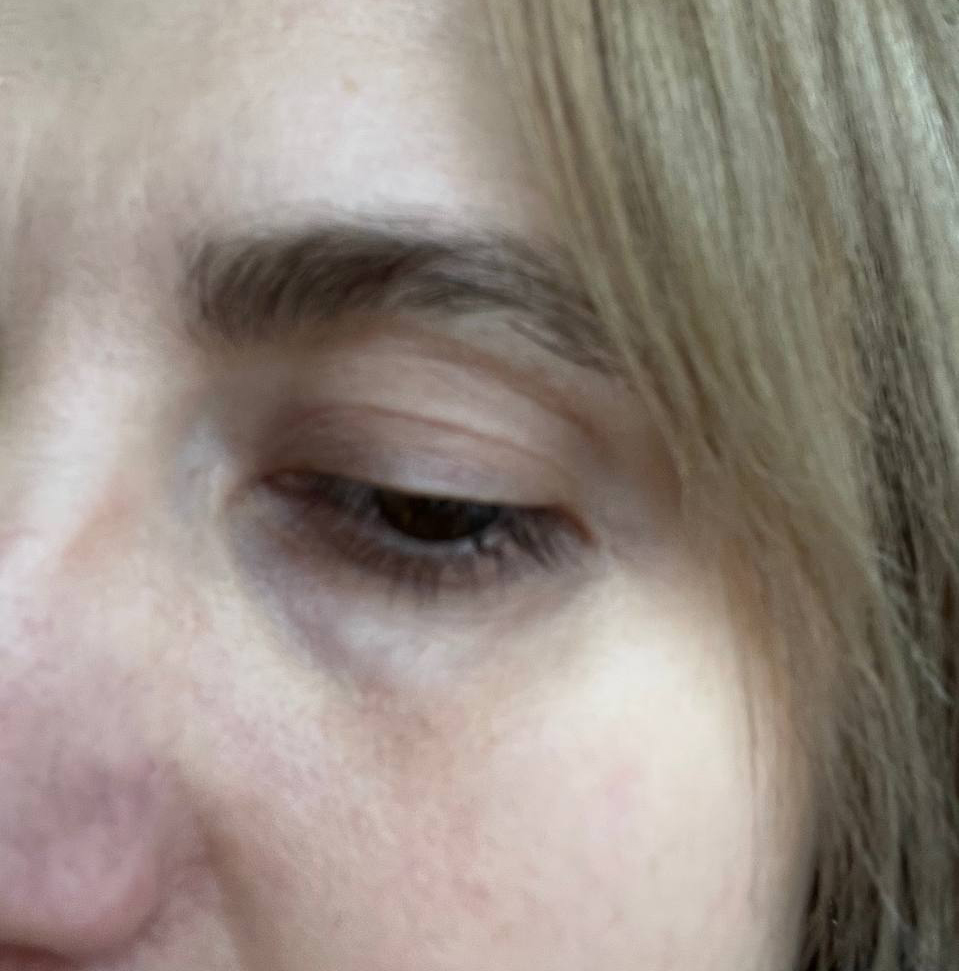 Как избавиться от мешков и синяков под глазами