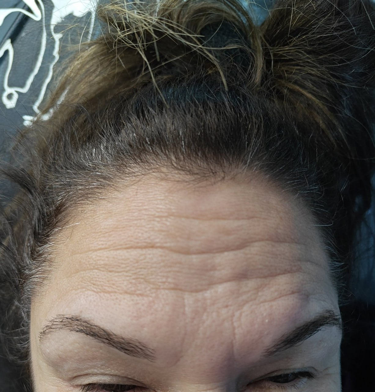 Как убрать заломы и морщины на лбу?